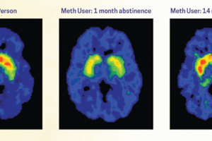 Meth Brain